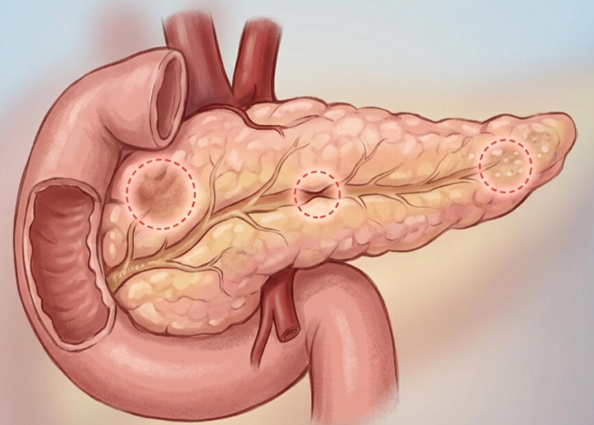 pancreas